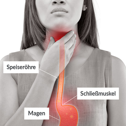 Mittel gegen Sodbrennen: Grafische Darstellung von Sodbrennen im Körper