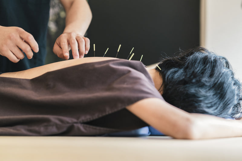 Person bekommt Akupunktur-Behandlung