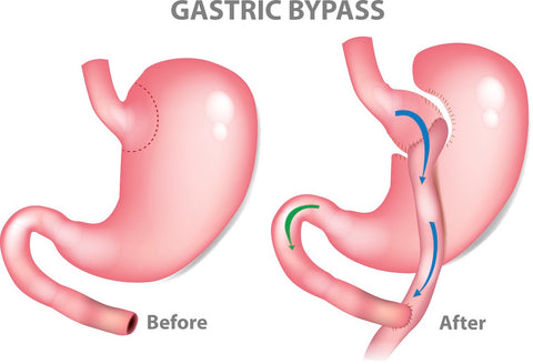 Infografik zum Magenbypass
