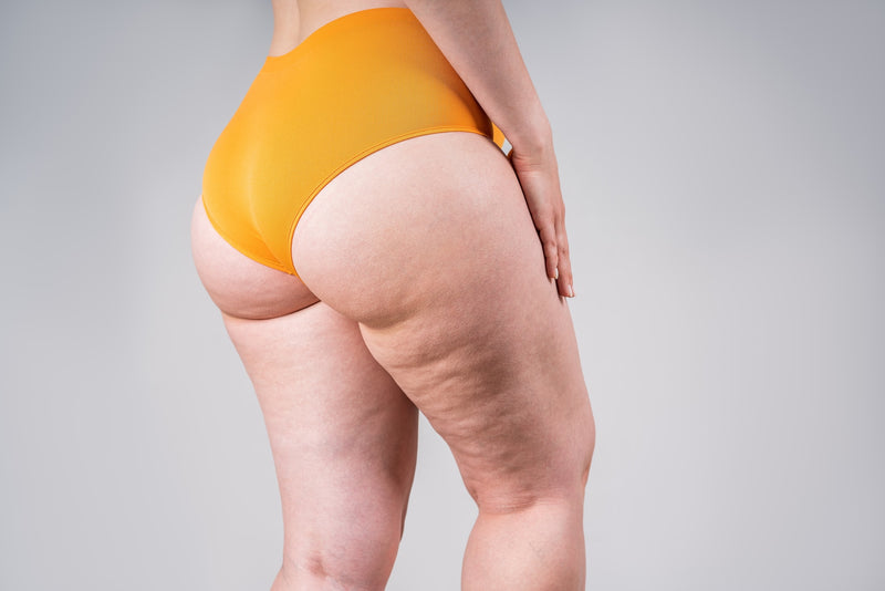 Cellulite oberschenkel