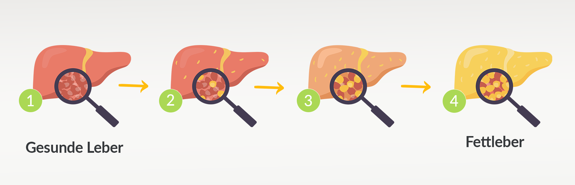 Fettleber Symptome Ursachen: Infografik Stadien einer Fettleber-Erkrankung