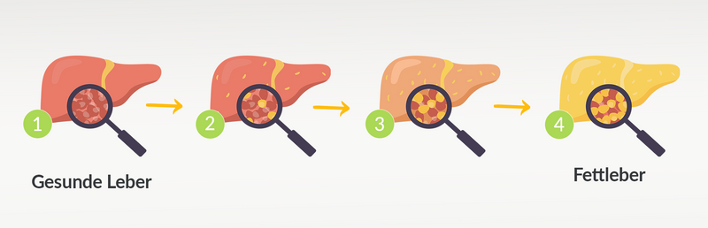 Infografik: Entstehung einer Fettleber