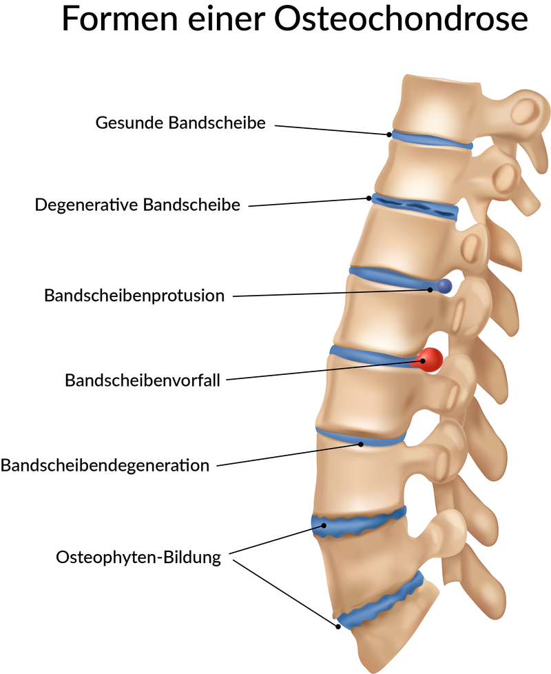 Osteochondrose Symptome, Ursachen, Therapie: Infografik Formen einer Osteochondrose