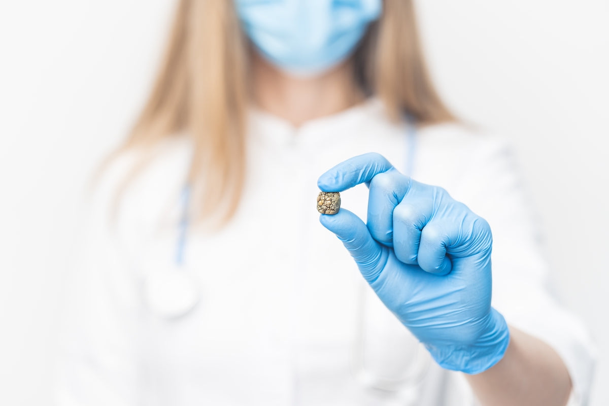 Ärztin zeigt einen Gallenstein