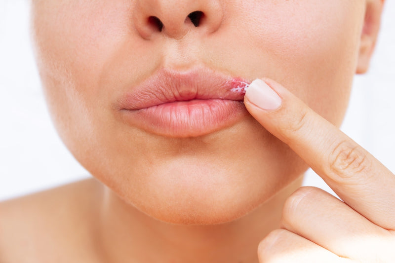 Frau cremt ihren Herpes an der Lippe ein