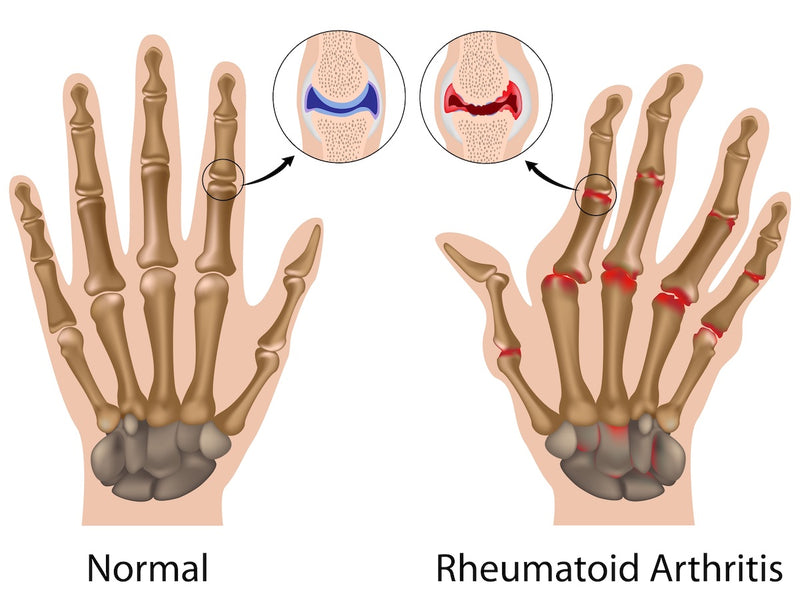 Vergleich einer gesunden Hand und einer Hand mit rheumatoider Arthritis