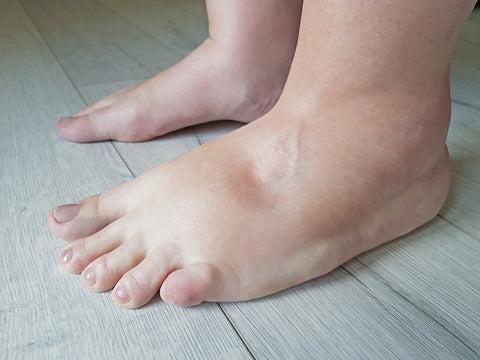 Angeschwollene Füße durch Wassereinlagerungen