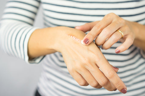 Frau trägt Salbe auf eine Wunde an der Hand auf