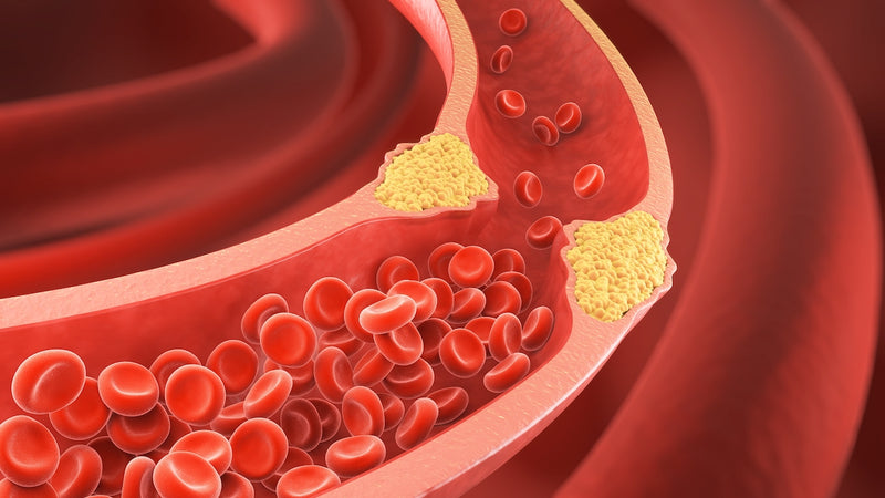 Cholesterin natürlich senken: Bildung eines Plaques im Blutgefäß